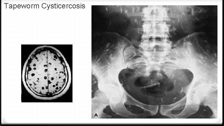 Tapeworm Cysticercosis 