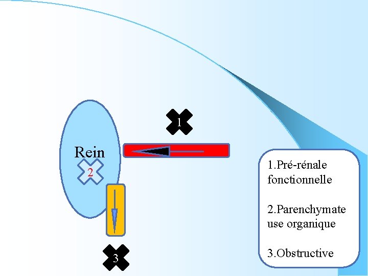 1 Rein 1. Pré-rénale fonctionnelle 22 2. Parenchymate use organique 3 3. Obstructive 