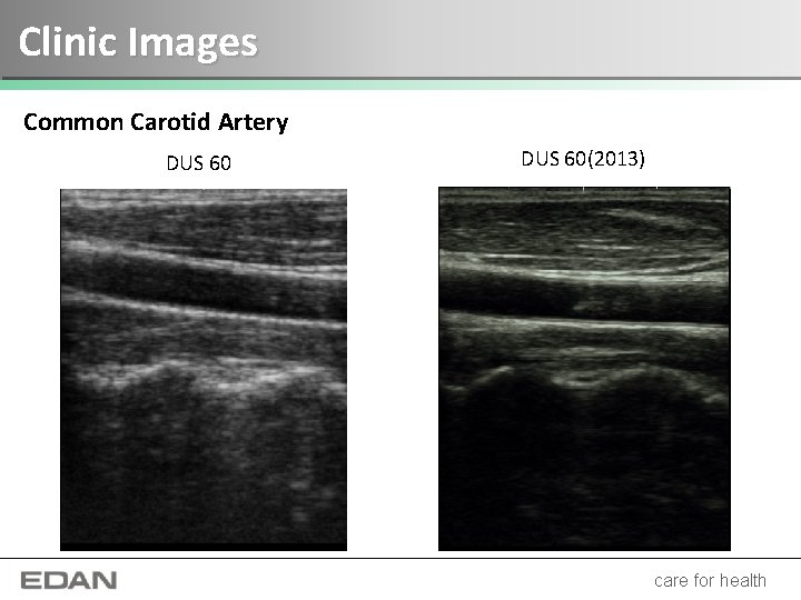 Clinic Images Common Carotid Artery DUS 60(2013) care for health 