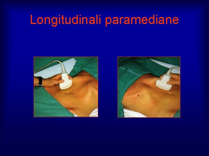 Longitudinali paramediane 