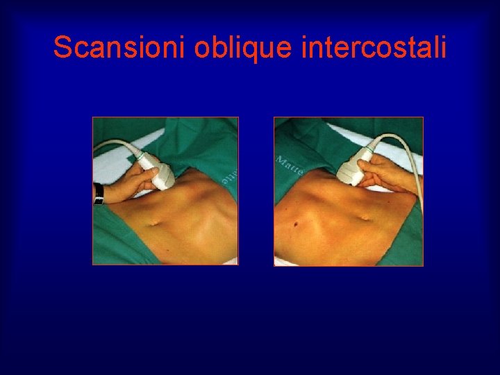 Scansioni oblique intercostali 