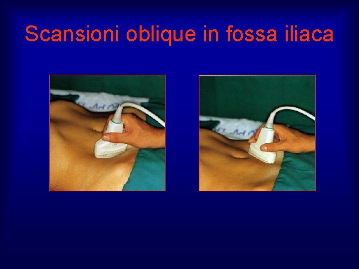 Scansioni oblique in fossa iliaca 
