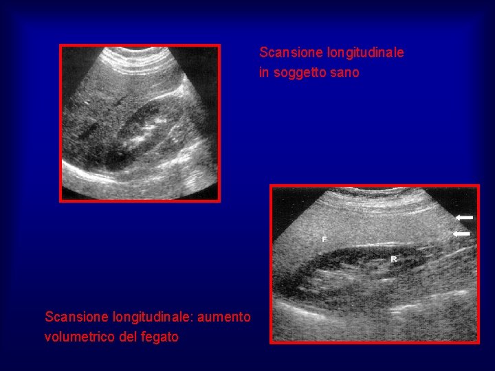Scansione longitudinale in soggetto sano Scansione longitudinale: aumento volumetrico del fegato 
