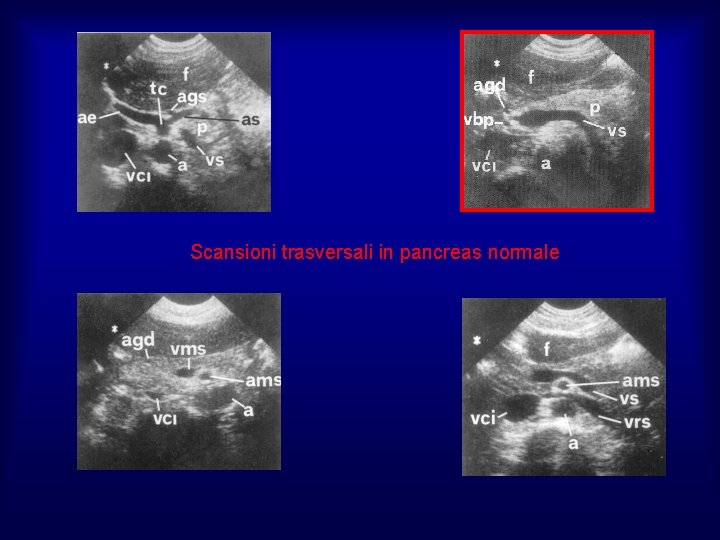 Scansioni trasversali in pancreas normale 