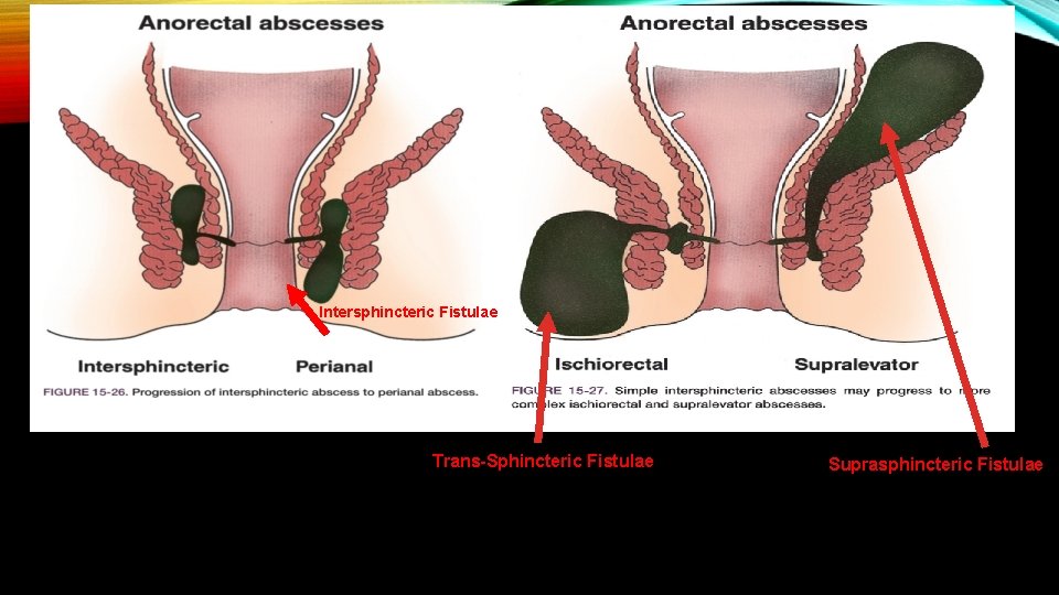 Intersphincteric Fistulae Trans-Sphincteric Fistulae Suprasphincteric Fistulae 