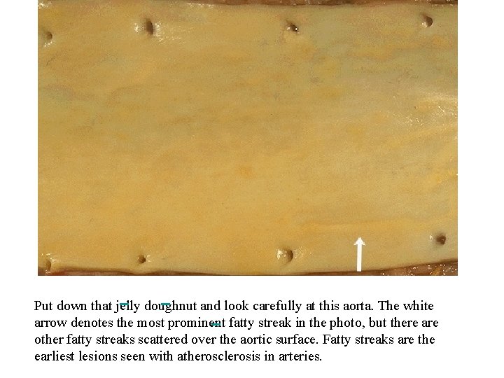 Put down that jelly doughnut and look carefully at this aorta. The white arrow Put down that jelly doughnut and look carefully at this aorta. The white arrow