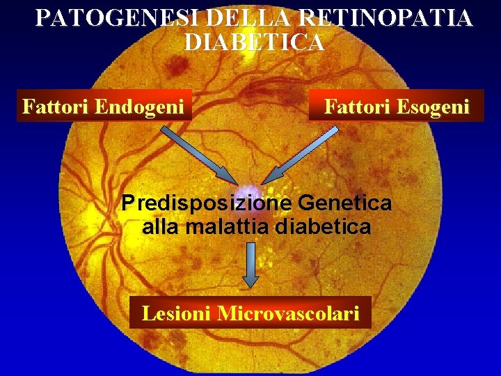 PATOGENESI DELLA RETINOPATIA DIABETICA Fattori Endogeni Fattori Esogeni Predisposizione Genetica alla malattia diabetica Lesioni