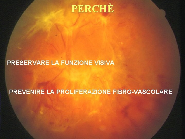 PERCHÈ PRESERVARE LA FUNZIONE VISIVA PREVENIRE LA PROLIFERAZIONE FIBRO-VASCOLARE 