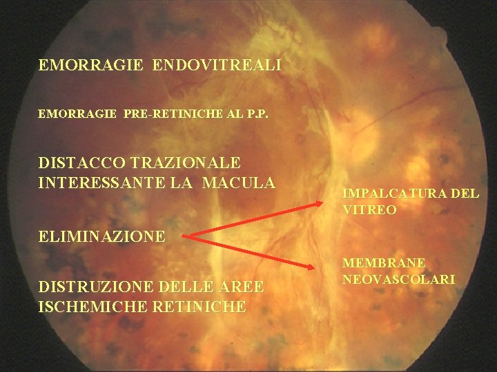 EMORRAGIE ENDOVITREALI EMORRAGIE PRE-RETINICHE AL P. P. DISTACCO TRAZIONALE INTERESSANTE LA MACULA IMPALCATURA DEL