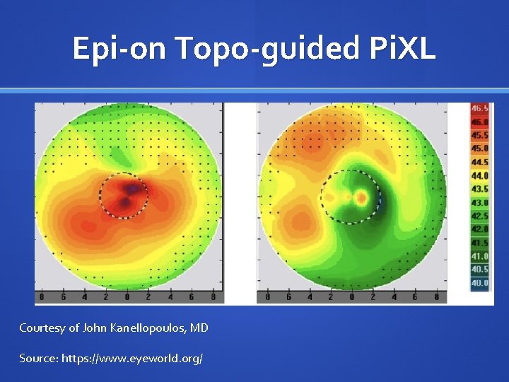 Epi-on Topo-guided Pi. XL Courtesy of John Kanellopoulos, MD Source: https: //www. eyeworld. org/