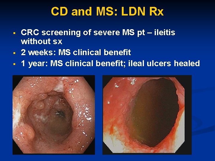 CD and MS: LDN Rx § § § CRC screening of severe MS pt