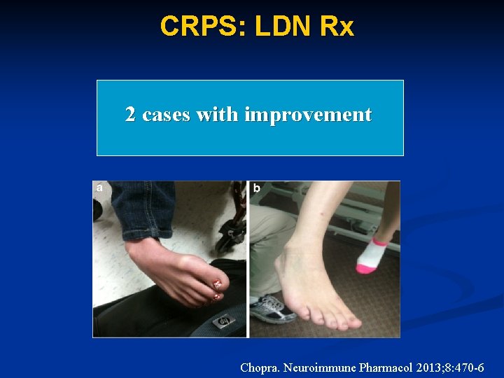 CRPS: LDN Rx 2 cases with improvement Chopra. Neuroimmune Pharmacol 2013; 8: 470 -6