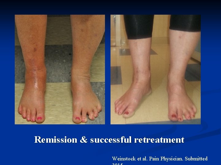 Remission & successful retreatment Weinstock et al. Pain Physician. Submitted 