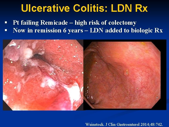 Ulcerative Colitis: LDN Rx § Pt failing Remicade – high risk of colectomy §