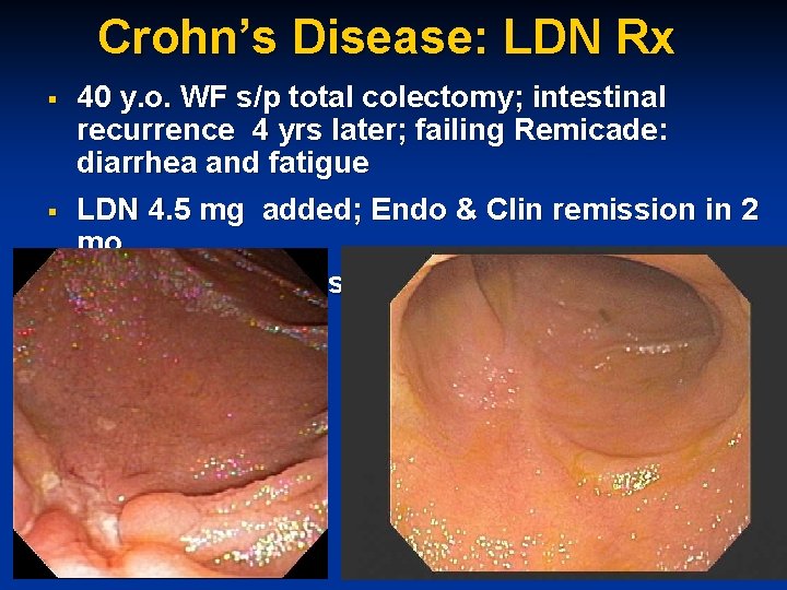 Crohn’s Disease: LDN Rx § § § 40 y. o. WF s/p total colectomy;