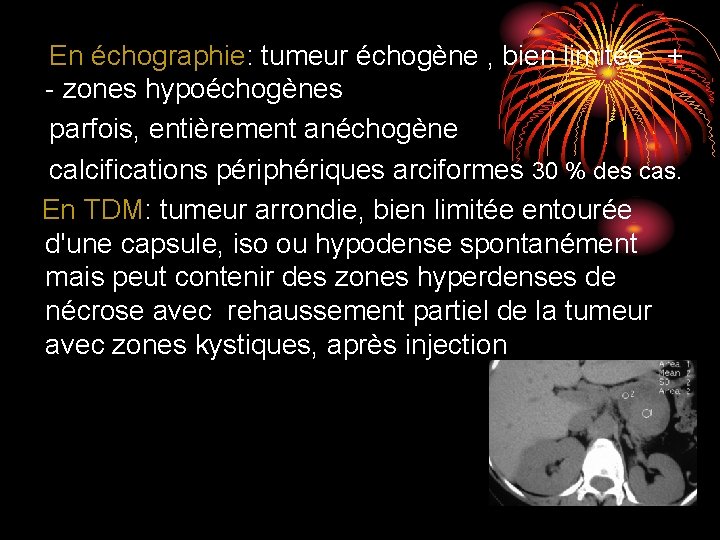 En échographie: tumeur échogène , bien limitée + - zones hypoéchogènes parfois, entièrement anéchogène En échographie: tumeur échogène , bien limitée + - zones hypoéchogènes parfois, entièrement anéchogène
