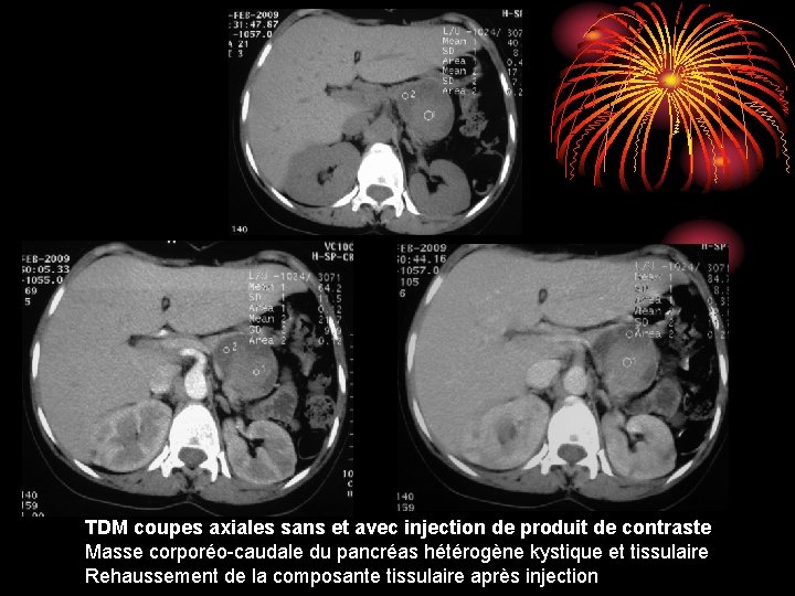 TDM coupes axiales sans et avec injection de produit de contraste Masse corporéo-caudale du TDM coupes axiales sans et avec injection de produit de contraste Masse corporéo-caudale du
