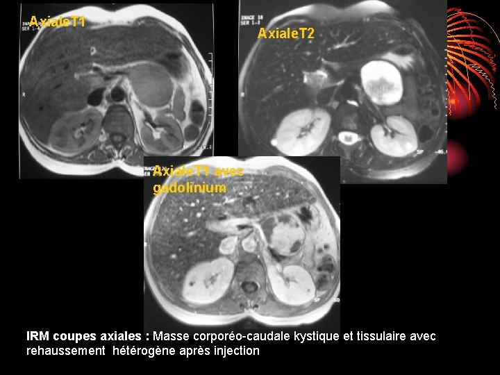 Axiale. T 1 Axiale. T 2 Axiale. T 1 avec gadolinium IRM coupes axiales Axiale. T 1 Axiale. T 2 Axiale. T 1 avec gadolinium IRM coupes axiales