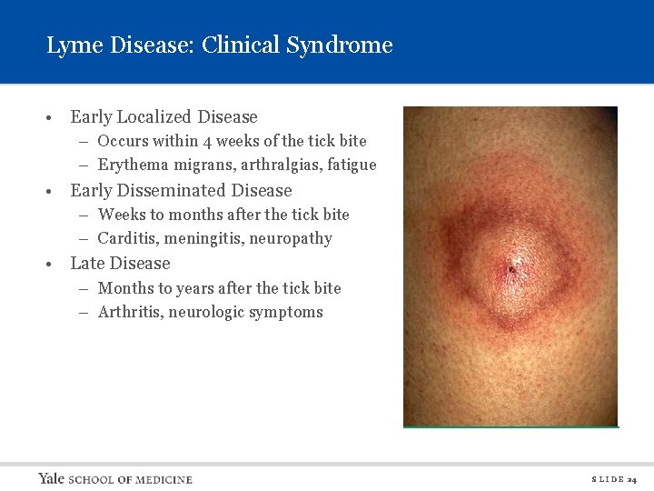 Lyme Disease: Clinical Syndrome • Early Localized Disease – Occurs within 4 weeks of