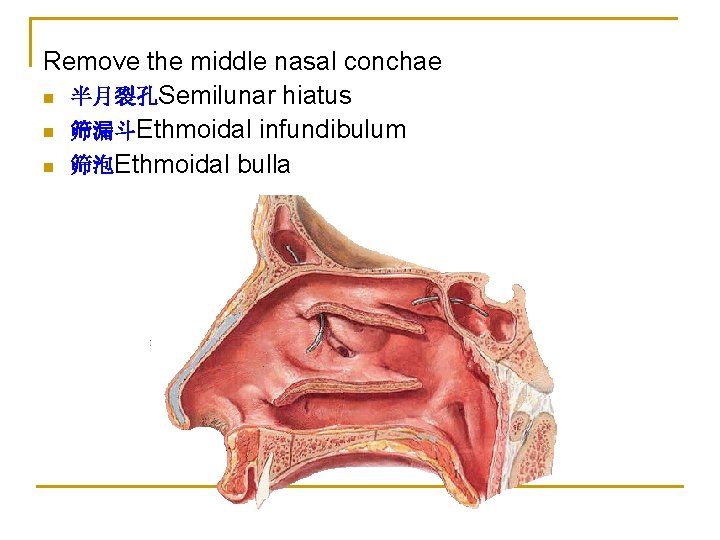 Remove the middle nasal conchae n 半月裂孔Semilunar hiatus n 筛漏斗Ethmoidal infundibulum n 筛泡Ethmoidal bulla