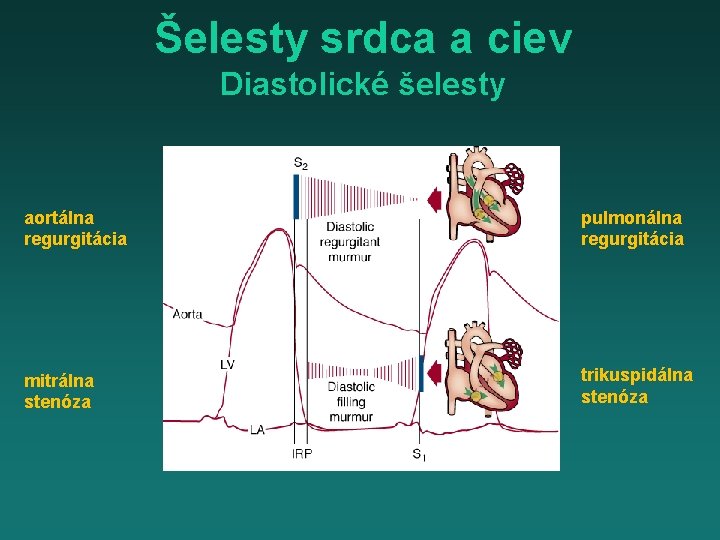 Šelesty srdca a ciev Diastolické šelesty aortálna regurgitácia pulmonálna regurgitácia mitrálna stenóza trikuspidálna stenóza