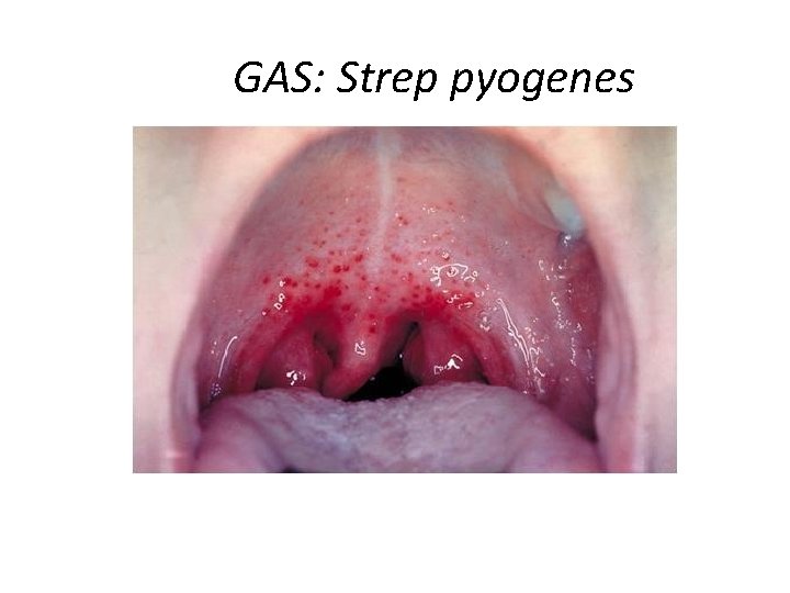 GAS: Strep pyogenes 