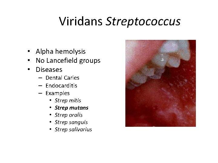 Viridans Streptococcus • Alpha hemolysis • No Lancefield groups • Diseases – Dental Caries