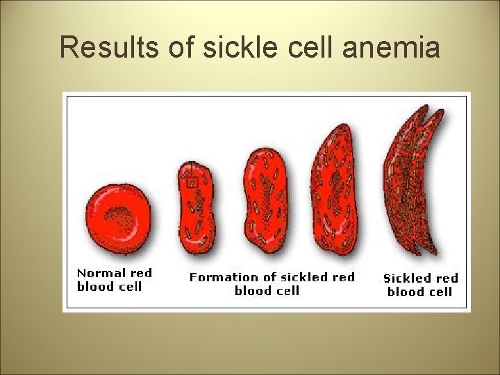 Results of sickle cell anemia 