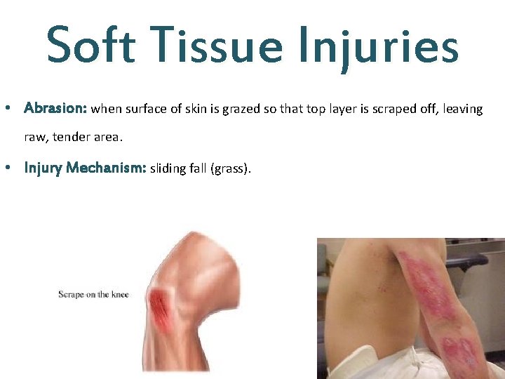 Soft Tissue Injuries • Abrasion: when surface of skin is grazed so that top