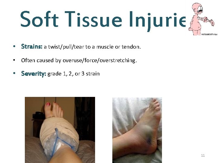 Soft Tissue Injuries • Strains: a twist/pull/tear to a muscle or tendon. • Often