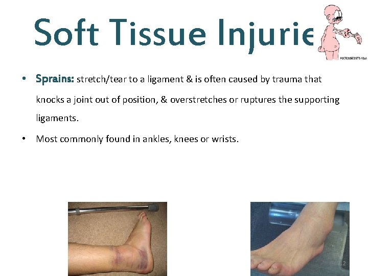 Soft Tissue Injuries • Sprains: stretch/tear to a ligament & is often caused by