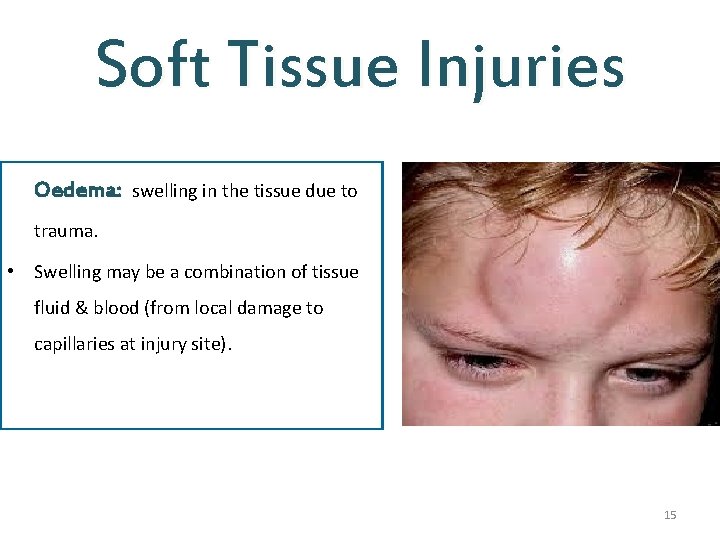 Soft Tissue Injuries Oedema: swelling in the tissue due to trauma. • Swelling may