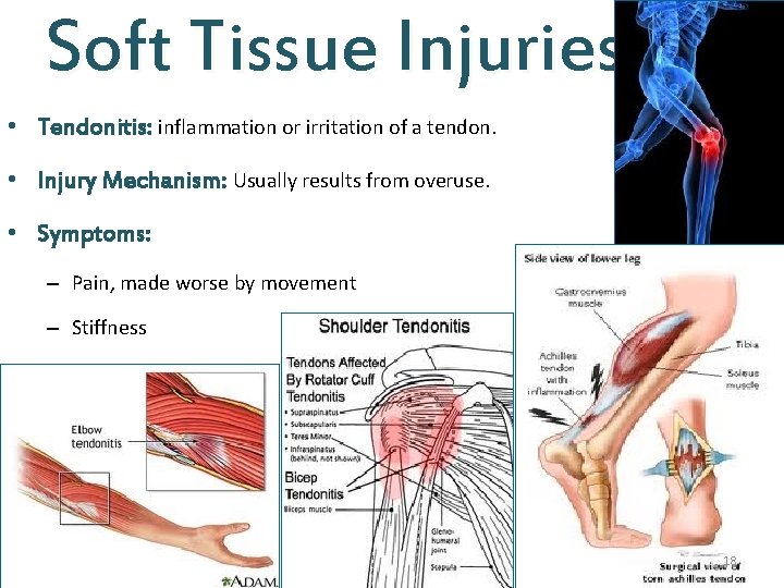 Soft Tissue Injuries • Tendonitis: inflammation or irritation of a tendon. • Injury Mechanism: