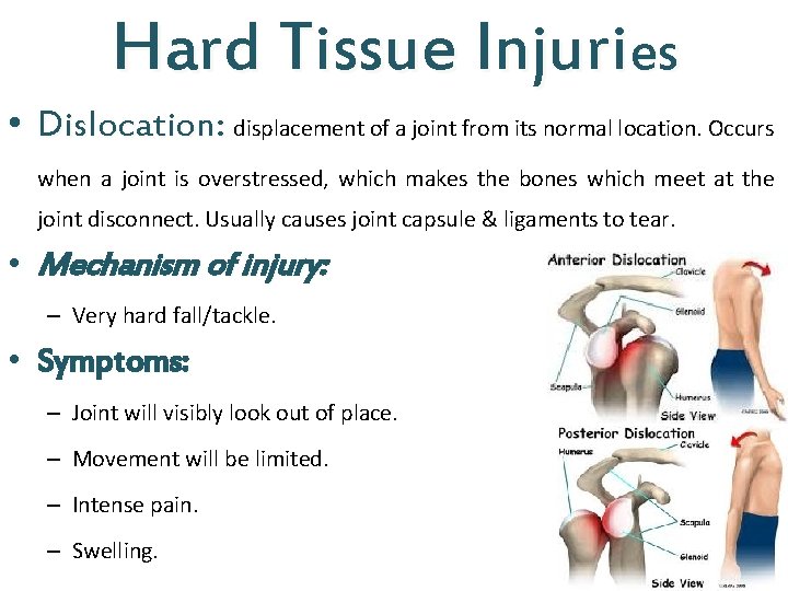 Hard Tissue Injuries • Dislocation: displacement of a joint from its normal location. Occurs