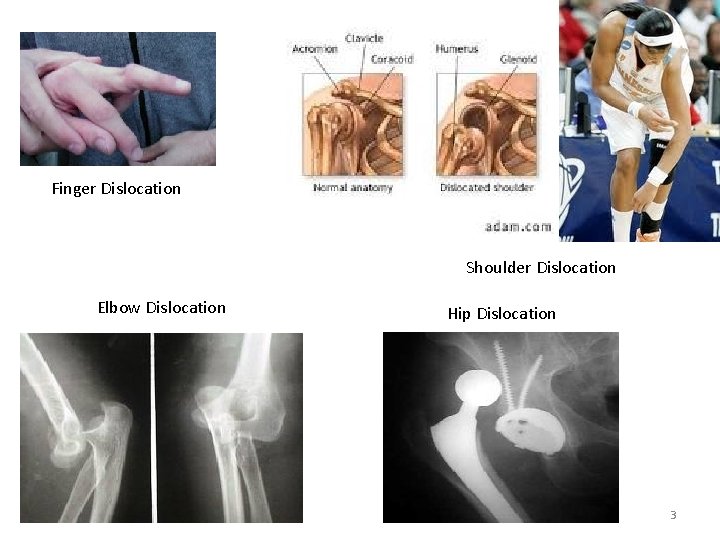 Finger Dislocation Shoulder Dislocation Elbow Dislocation Hip Dislocation 3 