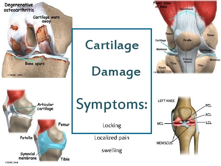 Cartilage Damage Symptoms: Locking Localized pain swelling 6 