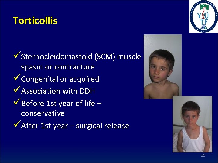 Torticollis üSternocleidomastoid (SCM) muscle spasm or contracture üCongenital or acquired üAssociation with DDH üBefore