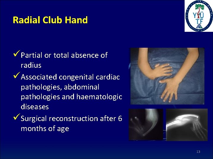 Radial Club Hand üPartial or total absence of radius üAssociated congenital cardiac pathologies, abdominal