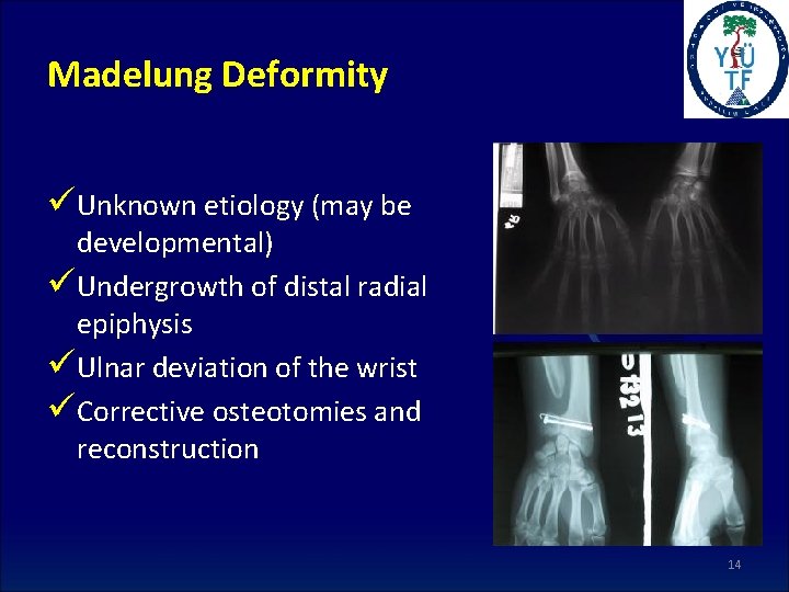 Madelung Deformity üUnknown etiology (may be developmental) üUndergrowth of distal radial epiphysis üUlnar deviation