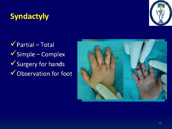 Syndactyly üPartial – Total üSimple – Complex üSurgery for hands üObservation for foot 15