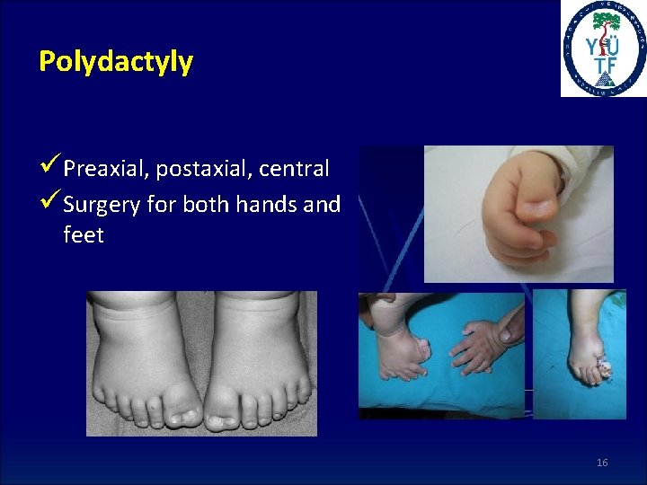 Polydactyly üPreaxial, postaxial, central üSurgery for both hands and feet 16 