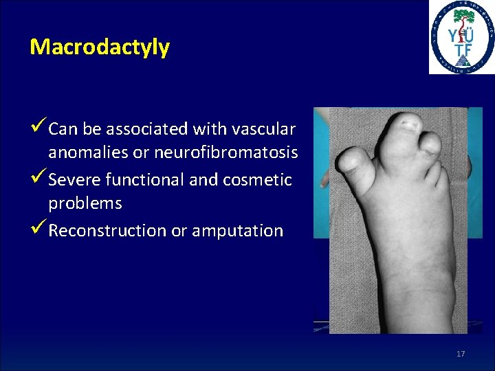 Macrodactyly üCan be associated with vascular anomalies or neurofibromatosis üSevere functional and cosmetic problems