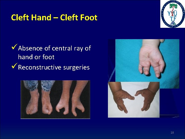 Cleft Hand – Cleft Foot üAbsence of central ray of hand or foot üReconstructive