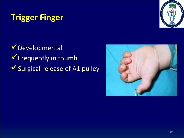 Trigger Finger üDevelopmental üFrequently in thumb üSurgical release of A 1 pulley 19 