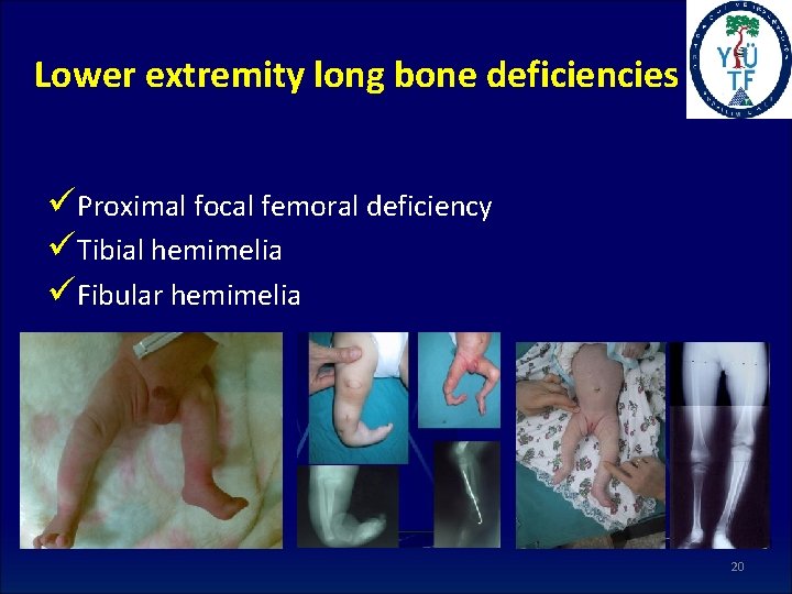 Lower extremity long bone deficiencies üProximal focal femoral deficiency üTibial hemimelia üFibular hemimelia 20
