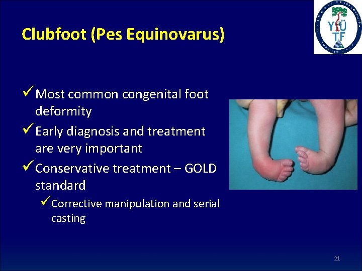 Clubfoot (Pes Equinovarus) üMost common congenital foot deformity üEarly diagnosis and treatment are very