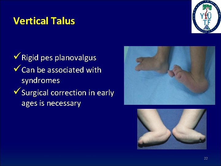 Vertical Talus üRigid pes planovalgus üCan be associated with syndromes üSurgical correction in early