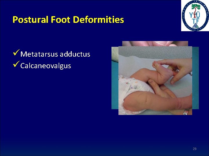 Postural Foot Deformities üMetatarsus adductus üCalcaneovalgus 23 