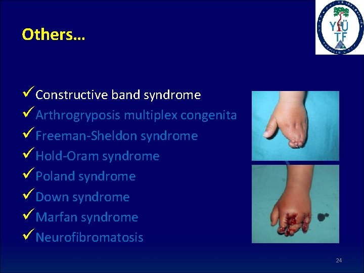 Others… üConstructive band syndrome üArthrogryposis multiplex congenita üFreeman-Sheldon syndrome üHold-Oram syndrome üPoland syndrome üDown