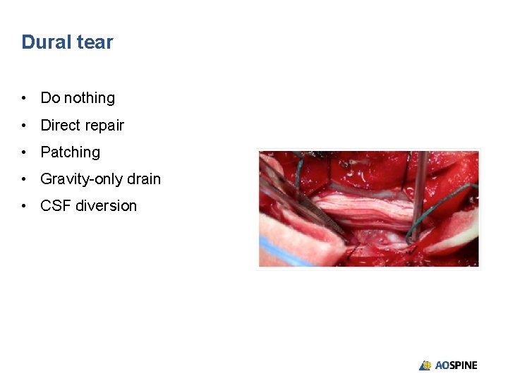 Dural tear • Do nothing • Direct repair • Patching • Gravity-only drain •